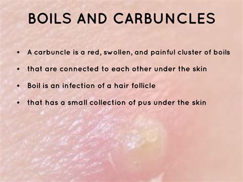 Boil On Neck Causes Carbuncle Mayo Clinic