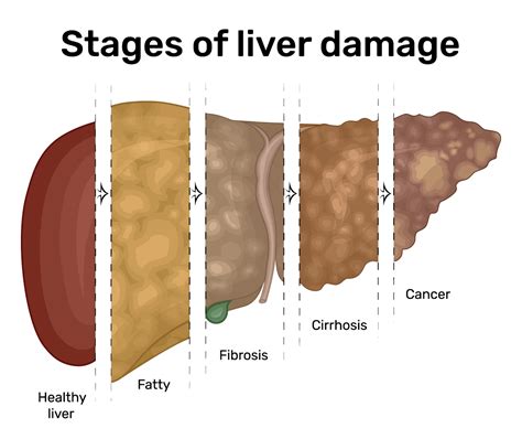 Liver Disease Advocate Health Care