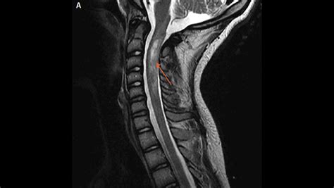Spinal Cord Lesions The Neurology Hub