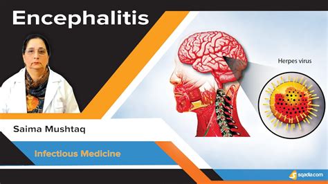 Encephalitis Clinical Manifestations And Etiology Lecture On