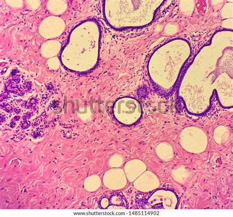 Microscopic Picture Breast Fibrocystic Changes Stock Photo 1485114902