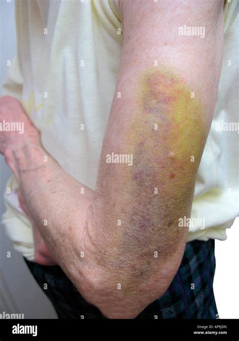 Frail Elderly Bruises Hi Res Stock Photography And Images Alamy