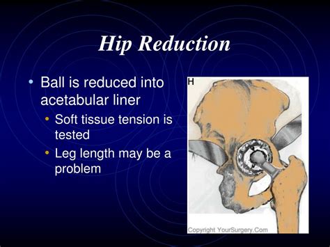 Ppt Hip Arthroplasty Powerpoint Presentation Free Download Id745056