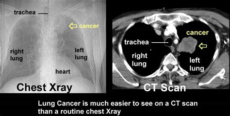 Xrays And Ct Scans Of Lung Cancer