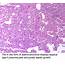 Pathology Outlines  Adenocarcinoma Overview
