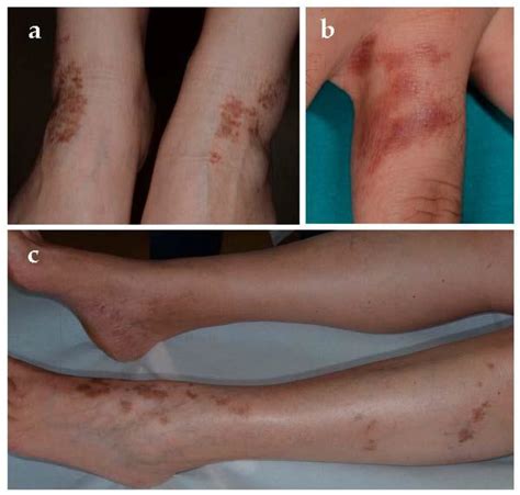 Jcm Free Full Text Pigmented Purpuric Dermatoses A Complete