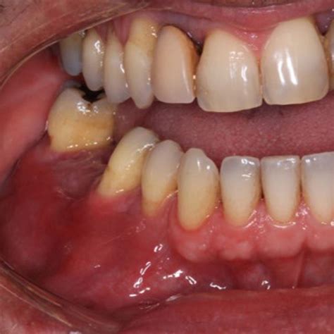 Intraoral Examination After The Treatment Showing Complete Remission Of