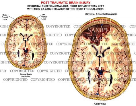 Post Traumatic Brain Injury — Medical Art Works