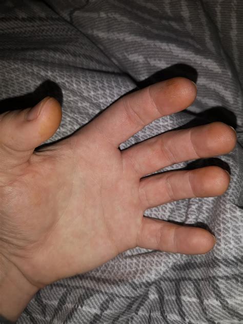It shows up as a scattering of orange, yellow or red although rust fungus is a classic culprit, there are other causes of leaf spotting that can look similar, so it is important to identify the cause before treating Fingertips are turning orange. Orange spots on hands too ...