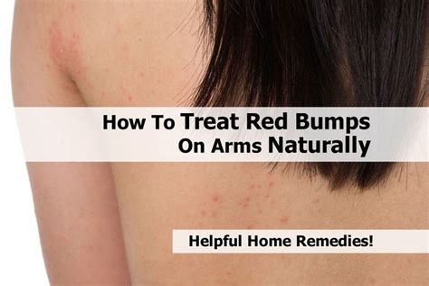 How To Treat Red Bumps On Arms Naturally Bumps On Arms Health