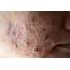  Cystic Acne Is The Most Aggressive Variant Of