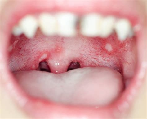 Infection Of Ulcer Inside Mouth Stock Image Image 80071169