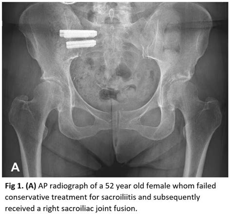 Figure Anteroposterior Radiograph Sacroiliitis Right Sacroiliac Joint Fusion StatPearls
