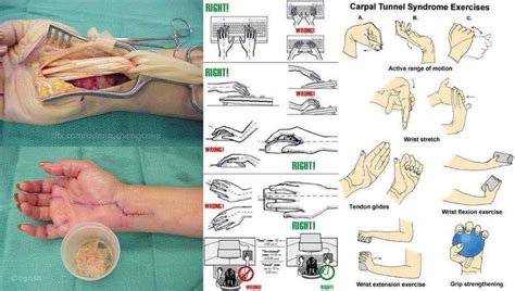 After carpal tunnel release, patients often undergo exercise rehabilitation. Carpal Tunnel Syndrome ExercisesActive range of ...