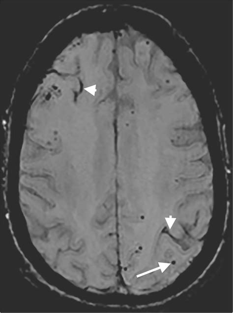 Cerebral Amyloid Angiopathy Mri