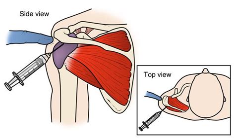 Shoulder Tendon Anatomy Rotator Cuff Tendinitis Johns Hopkins