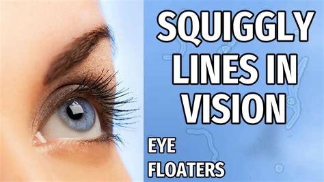 Squiggly Lines In Vision What Causes Floaters In Your Eyes Youtube