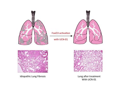Pulmonary Fibrosis Caused By Single Transcription Factor