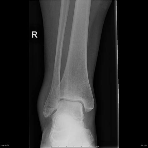 Ankle Fracture Weber A Image
