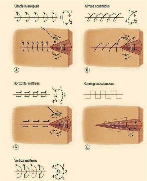 Medical Doctors Worldwide On Instagram “different Types Of Suturing