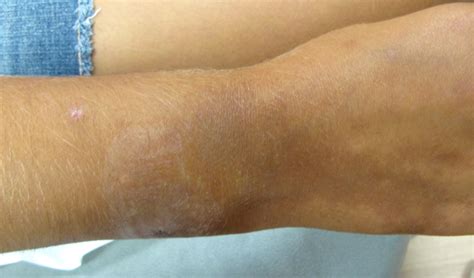 Discolored Patches From Wrist To Elbow Clinical Advisor