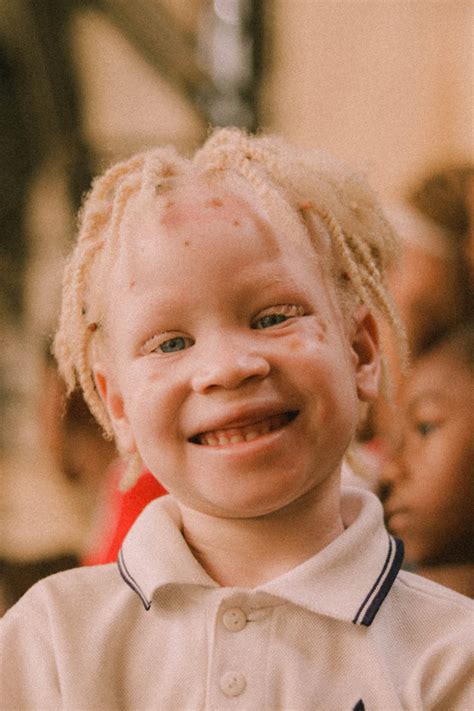 Can Albino People Dye Their Hair Detailed Guide Beauty Milly