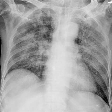 Follow Up Chest X Ray On The 5th Day Of Admission Showing Bilateral