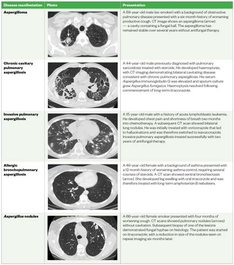 Aspergillosis Causes Types And Treatment The Pharmaceutical Journal