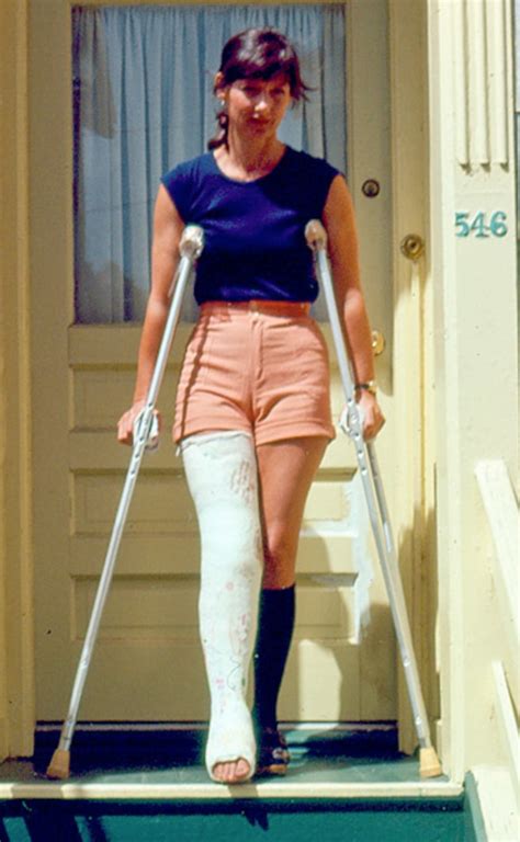 Llc Long Leg Cast Milwaukee Brace Full Body Cast Long Leg Cast Crutches Amputee Broken Leg