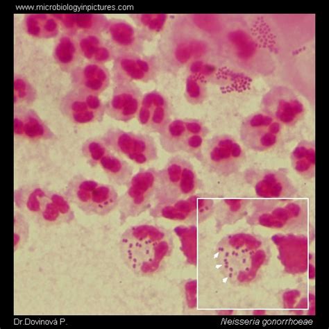 Днк гонококка (neisseria gonorrhoeae), количественно. Gonococcus (Neisseria gonorrhoeae) Gram-stain and cell ...