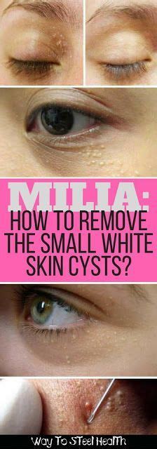 Milia How To Remove The Small White Skin Cysts Petite Peau Verrues