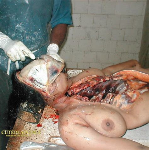 Nude Girl Naked Dead Woman Autopsy Repicsx Com