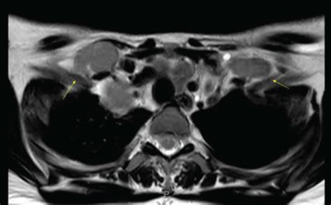 T2 Weighted Sequence Bilateral Supraclavicular Lymphadenopathy