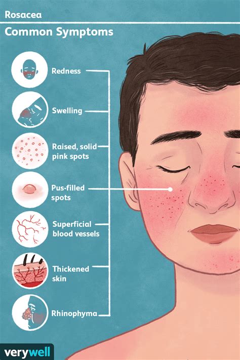 Rosacea Signs Symptoms And Complications