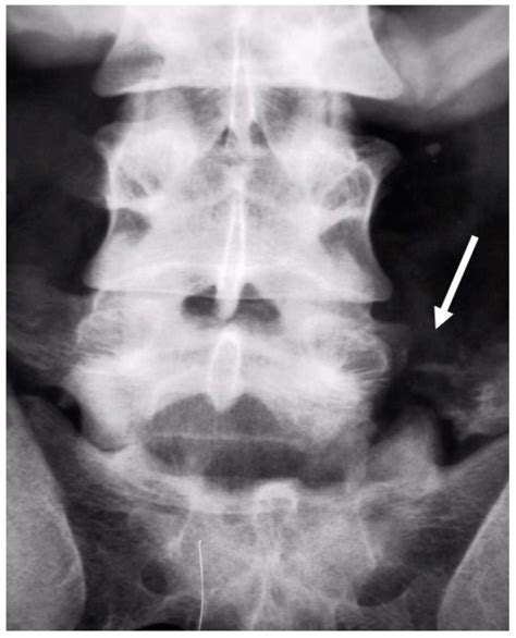 Transverse Process Fracture X Ray