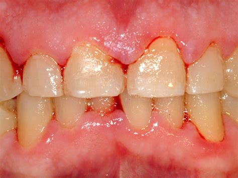 Zahnfleischerkrankungen Ursachen Symptome Von Gingivitis