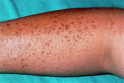 Pigmented Naevi Moles On The Arm Of A Patient Photograph By Dr P