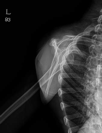 Ewing S Sarcoma Of Scapula Image Radiopaedia Org