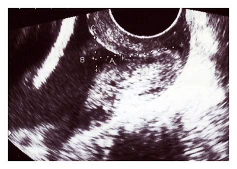 Transvaginal Ultrasound Image Of The Cervical Funneling Download