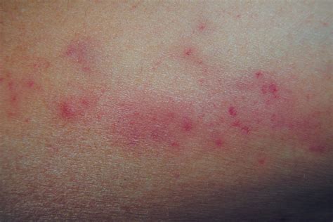 Petechiae In Children Causes When To Worry Pictures And More