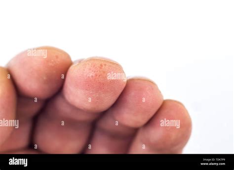 Eczema Skin Blisters Hi Res Stock Photography And Images Alamy