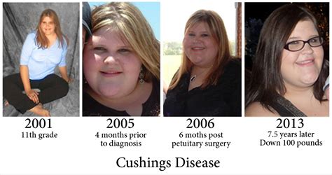 A Little Less Mommy Cushings Disease