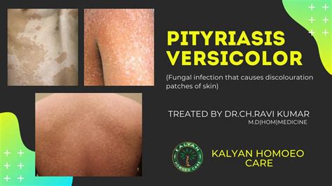 Best Pityriasis Versicolor Treatment In Homeopathy Drravi Kumarmd