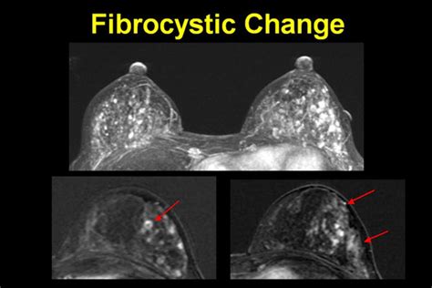 Diseases Fibrocystic Breast Disease