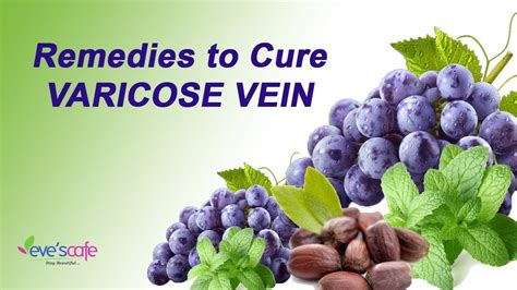 Natural Home Remedies To Cure Varicose Veins 100 Natural Youtube