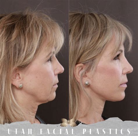 Direct Necklift Dr Douglas Henstrom Utah Facial Plastics