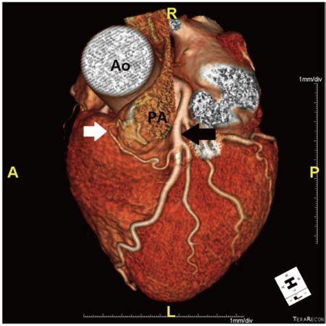 Background the coronary sinus is the main cardiac vein and it has become a clinically important structure especially through its role in providing access for different cardiac procedures. Fistula between proximal LAD and pulmonary trunk. Volum ...