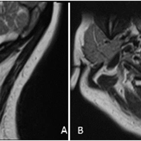 Preoperative A Sagittal And B Axial Imaging Download Scientific
