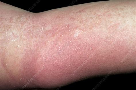 Allergic Rash Stock Image C0024041 Science Photo Library