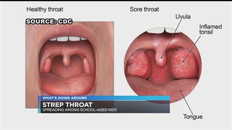 Whats Going Around Strep Throat